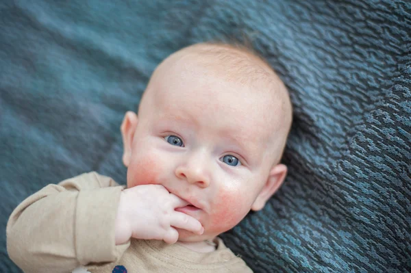 Niño pelirrojo con dermatitis atópica — Foto de Stock