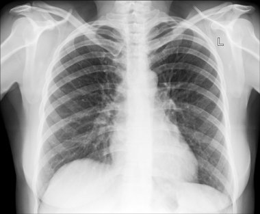 tıbbi tanı için insan göğüs x-ray görüntüsü