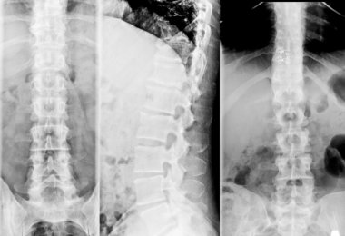 İnsan Göğsünün X-Ray Görüntüsü