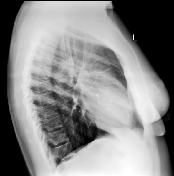 Imagen de Rayos X del Pecho Humano para un diagnóstico médico — Foto de Stock
