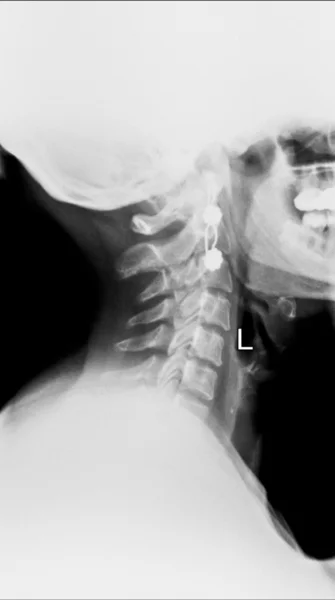 Tıbbi tanı için insan göğüs x-ray görüntüsü — Stok fotoğraf