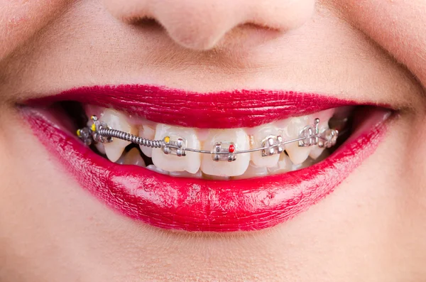 Woman with brackets — Stock Photo, Image