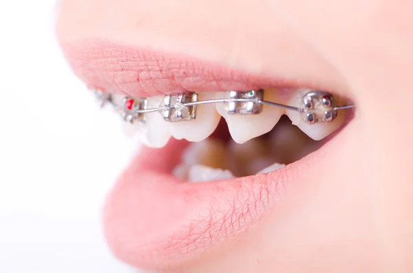 Mouth with brackets braces in medical concept — Stock Photo, Image