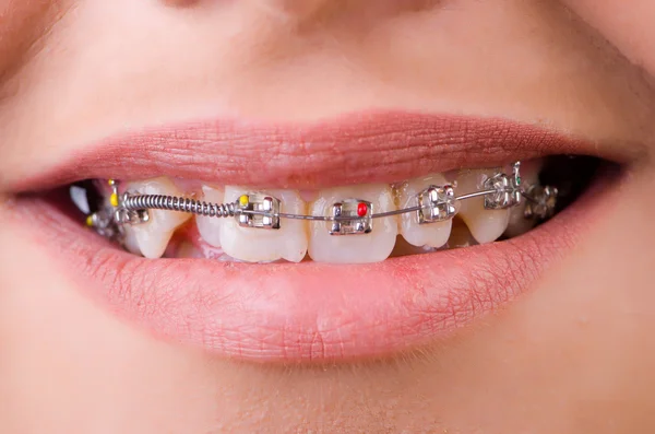 Mund mit Brackets in medizinischem Konzept — Stockfoto