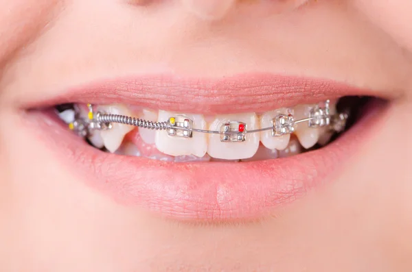 Mouth with brackets braces in medical concept — Stock Photo, Image