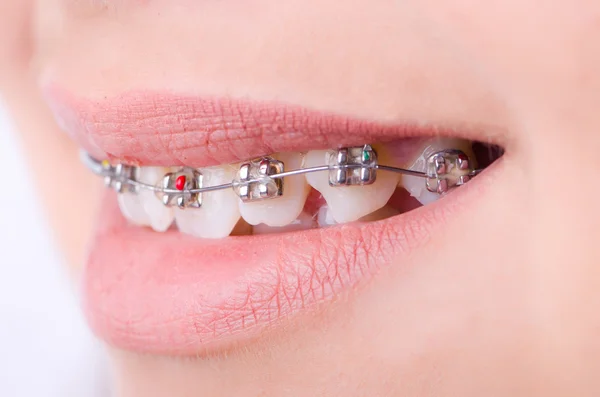 Mund mit Brackets in medizinischem Konzept — Stockfoto