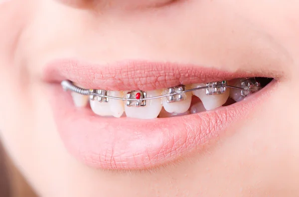 Mouth with brackets braces in medical concept — Stock Photo, Image