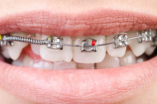 Mouth with brackets braces in medical concept — Stock Photo, Image