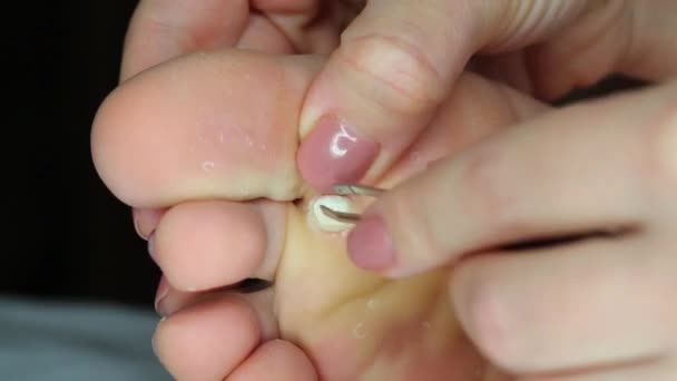 Female hand removes part of warts on on sole of female feet — Stock Video