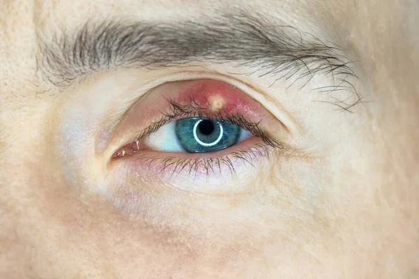 Chalazion auf Augenhöhe. Augenlidentzündung — Stockfoto