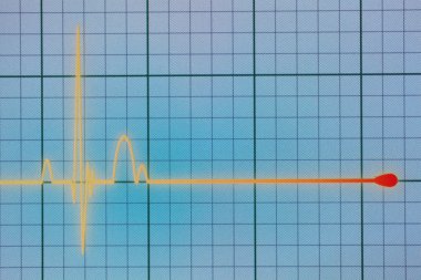 EKG - Ekg monitör