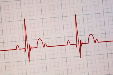 EKG - Ekg monitör