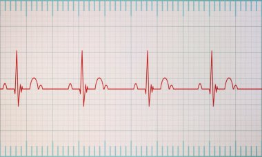 EKG - Ekg monitör