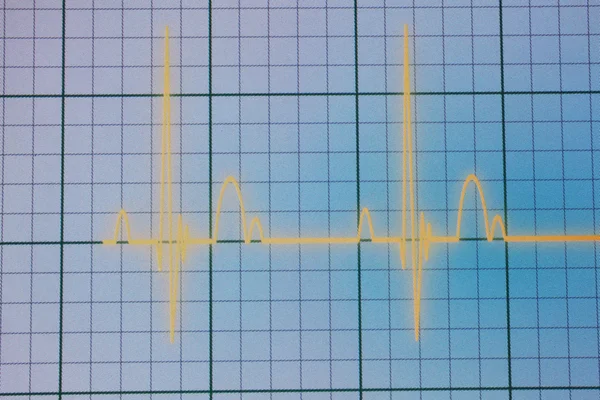 EKG - Ekg monitör — Stok fotoğraf
