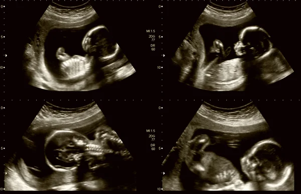 Medizinische Bilder Collage von Ultraschall während der Schwangerschaft der Frau zeigen — Stockfoto