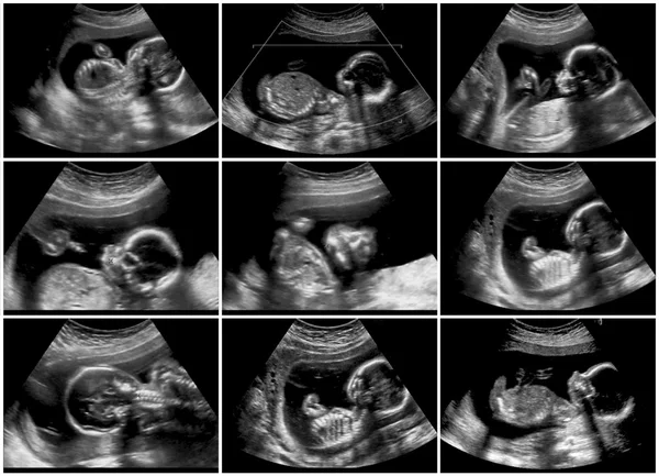 ecografia 4d bebe 20 semanas