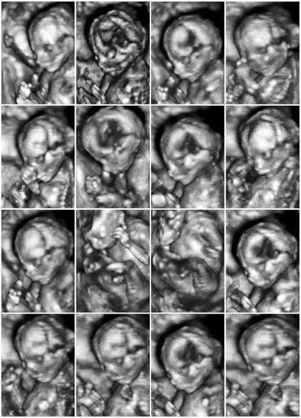 3d ultrason anomali taraması 16 tıbbi resim kolaj bir — Stok fotoğraf