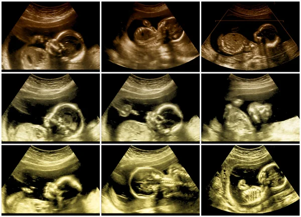 Series of 9 fetal sonograms pictures — Stock Photo, Image