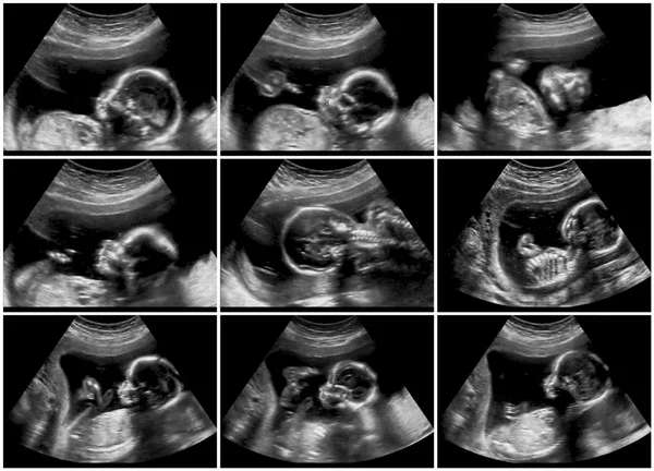 Echografie scant collage tijdens de zwangerschap aan het einde van de derde ma — Stockfoto