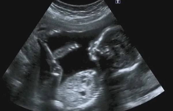 Ultrasonography Analysis of a 4th Month Fetus — Stock Photo, Image