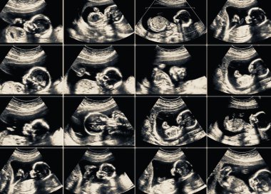 16 Ultrasonografi fetus resim kolaj