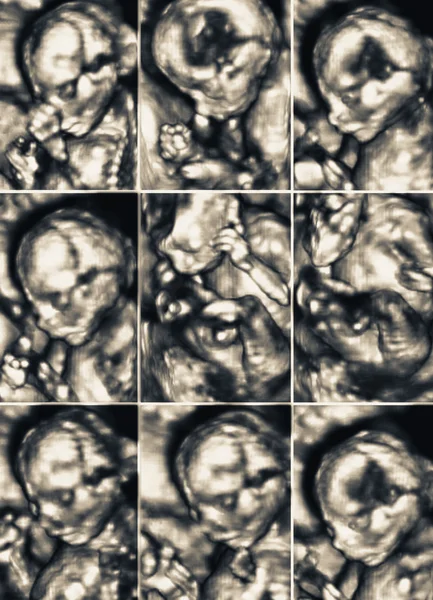 Ultrasound of a young fetus inside the womb. Collection of nine — Stock Photo, Image