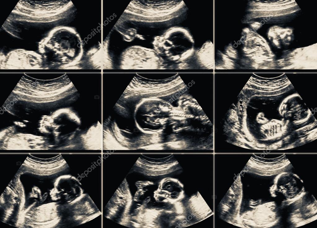 Ultrasound scans collage during pregnancy at the end of third mo