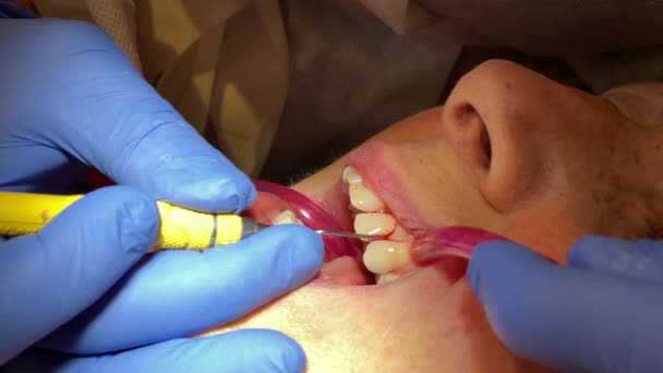 Mujer que recibe tratamiento dental en el consultorio de dentistas. Mujer está siendo tratada para la limpieza de dientes — Vídeo de stock