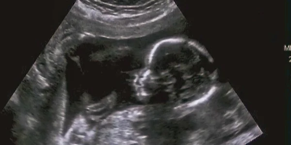 Ultrasonography Analysis 4Th Month Fetus Italy — Stock Photo, Image