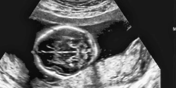 Ultrasonography Analysis 4Th Month Fetus Italy — Stock Photo, Image