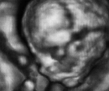 4. Ay Fetüsü 'nün 3D Ultrasonografi Analizi, İtalyan Laboratuvarları