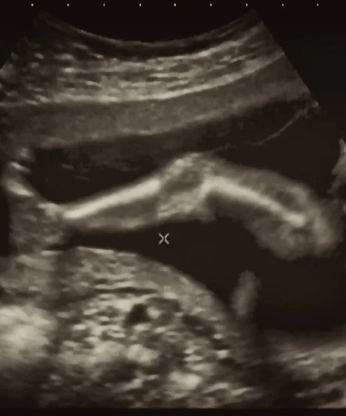 Ultraschalluntersuchung Eines Fetus Monat Italien — Stockfoto