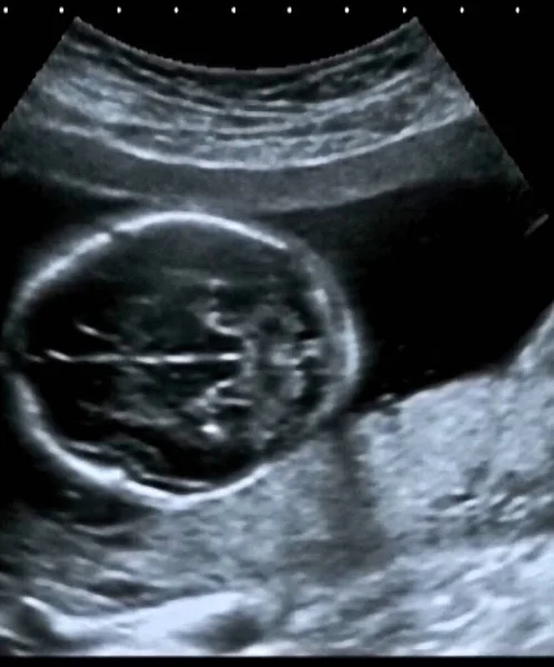 Ultrasonography Analysis 4Th Month Fetus Italy — Stock Photo, Image