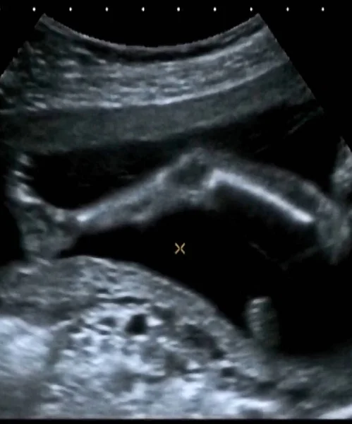 Ultraschalluntersuchung Eines Fetus Monat Italien — Stockfoto