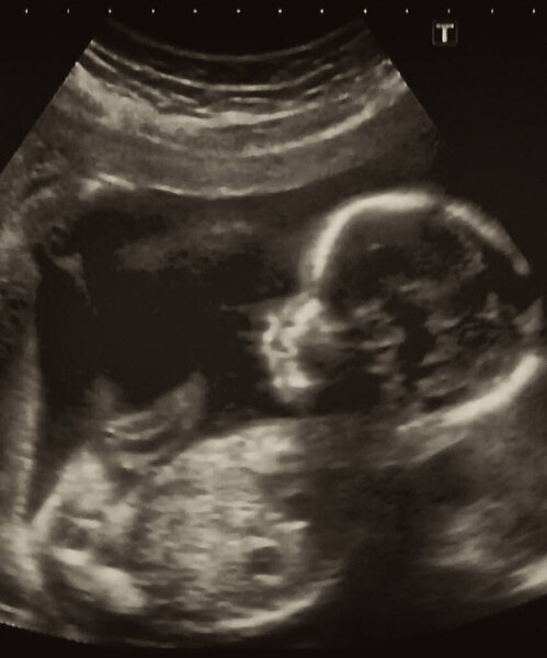 Ultrasonography Analysis of a 4th Month Fetus, Italy