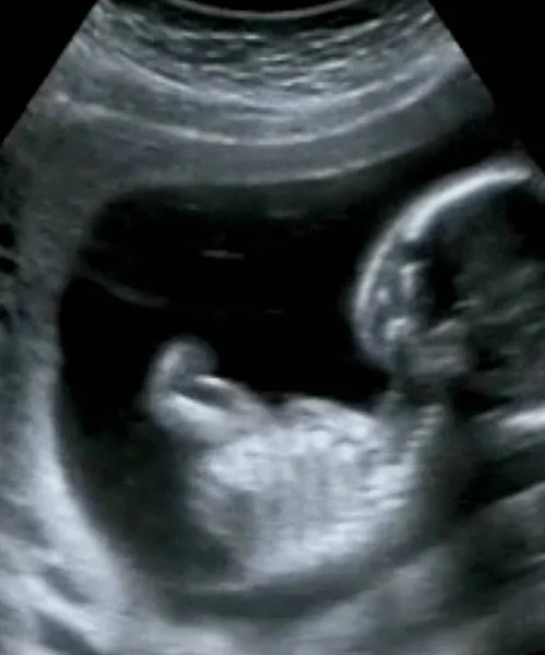 Verloskundige Ultrasonografie Echografie Van Een Vierde Maand Foetus — Stockfoto