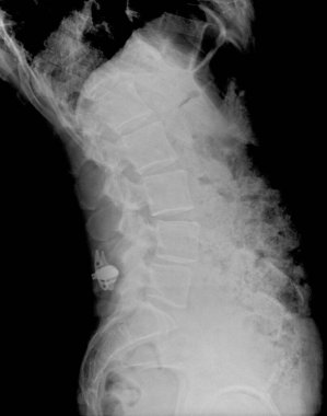 Röntgen, lumbo-sakral omurga ve pelvis. İnceleme taraması.