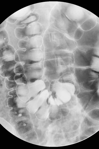 Kalın Bağırsağın Kalın Bağırsak Röntgen Incelemesi Baryum Lavmanı Çift Kontrastlı — Stok fotoğraf