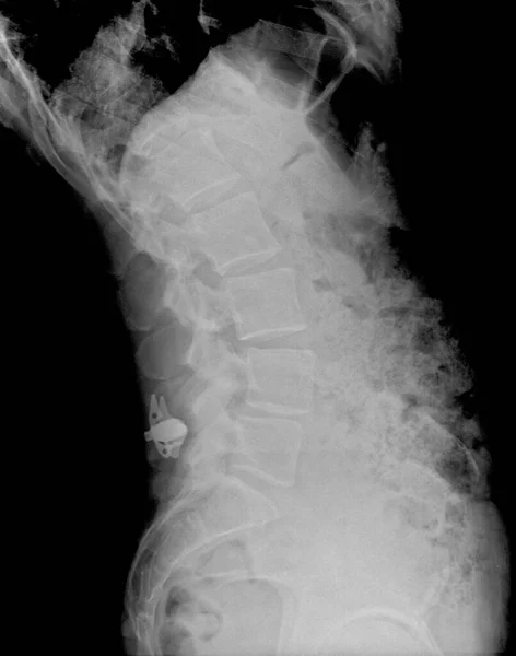 Röntgenstrålning Ländryggen Och Bäckenet Undersökning — Stockfoto
