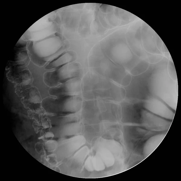Examen Rayos Examen Enema Bario Con Película Puntual Gastrointestinal Inferior —  Fotos de Stock