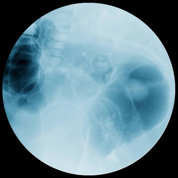 Imagem Enema Bário Radiografia Colorretal Mostrando Anatômica Intestino Grosso Cólon — Fotografia de Stock