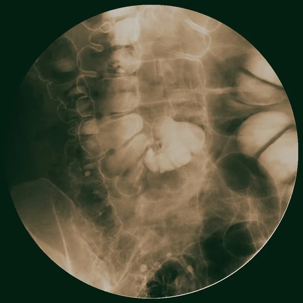 大腸や大腸の解剖学的構造を示す大腸や大腸のバリウムの画像やX線画像 大腸がんの診断用付録 — ストック写真