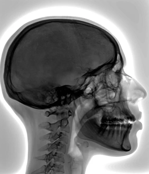 Widok Boczny Ludzkiego Mózgu Prześwietlenie Medyczne — Zdjęcie stockowe