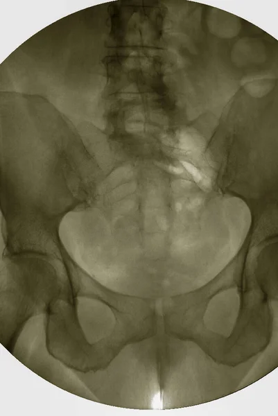 大肠或大肠解剖学诊断大肠直肠癌的钡灌肠图像或大肠直肠X线平片 — 图库照片