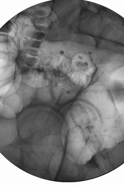 Barium Klistier Oder Röntgenbild Des Dickdarms Kolorektale Röntgenaufnahme — Stockfoto