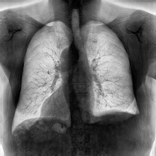 Σάρωση Ακτίνες Του Ανθρώπινου Θώρακα Και Των Πνευμόνων — Φωτογραφία Αρχείου