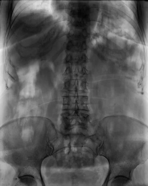 Ray Lumbo Sacral Spine Pelvis Examination Scan — Stock Photo, Image