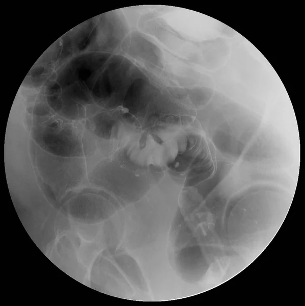 Barium Enema Image Ray Image Large Intestine Colon Showing Anatomical — Stock Photo, Image