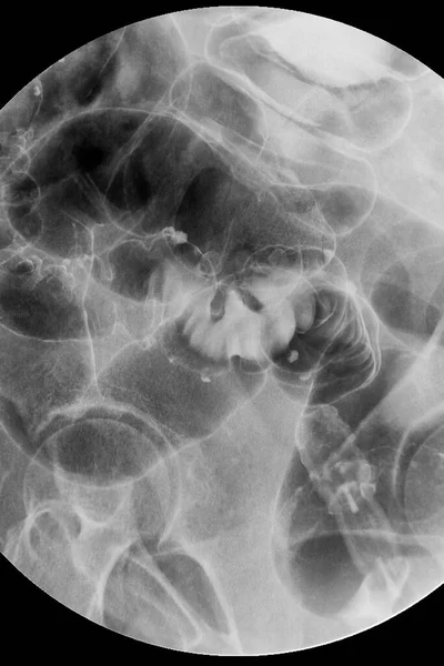 Sluit Röntgenfoto Barium Klysma Onderzoek Colorectale Röntgenfoto — Stockfoto