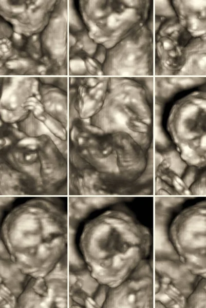 Foto Ultrasound Bayi Rahim Ibu Kolase Gambar Ekografi — Stok Foto